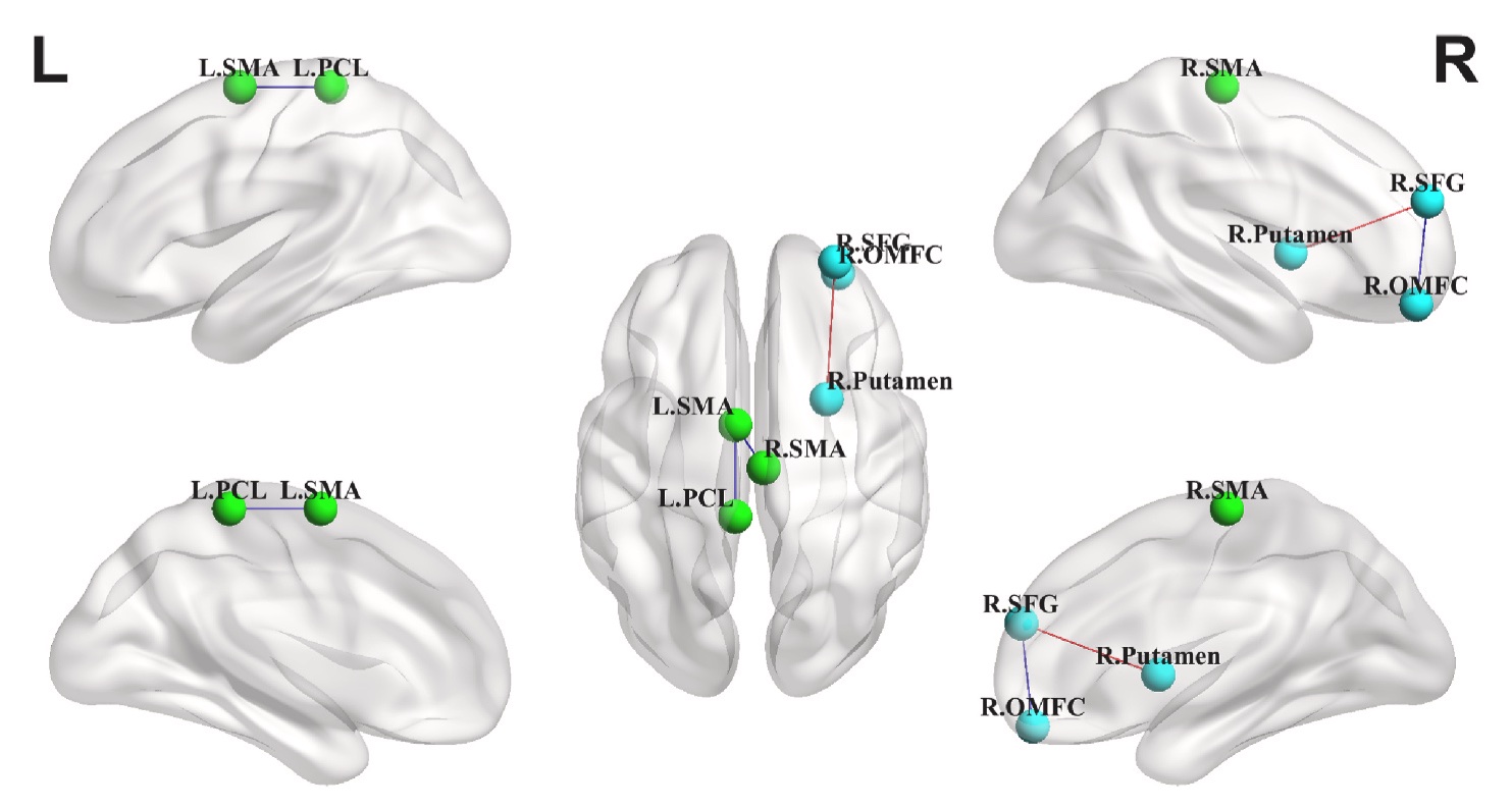 Glass-brain views with labeled nodes in the left and right supplementary motor area, left paracentral lobule, right superior frontal gyrus, right orbital middle frontal cortex and right putamen, joined by red and blue edges.