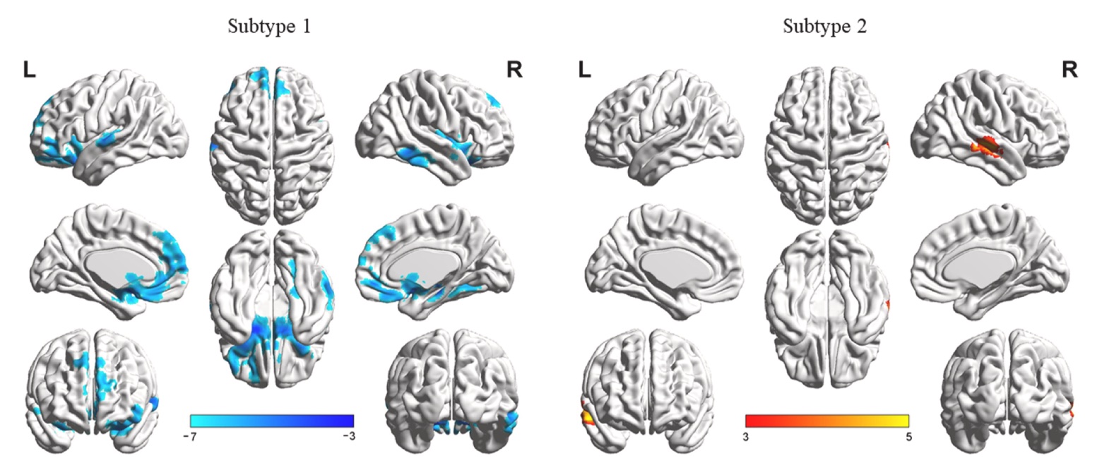 Brain surface maps for two insomnia subtypes. Subtype 1 shows blue patches of reduced gray matter across frontal, temporal and occipital cortex. Subtype 2 shows one red-yellow patch of increased gray matter in the right superior temporal gyrus.